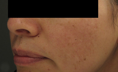 Laser Treatments Bangor ME Penobscot Medical Aesthetics